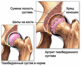 Артрит от артроза тазобедренный сустав Артрит от артроза тазобедренный сустав