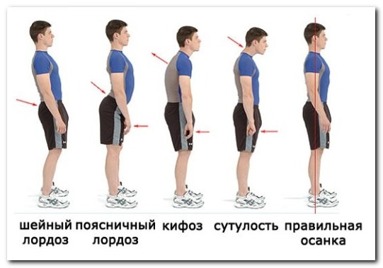 лордоз поясничного и шейного отдела поясничный и шейный лордоз