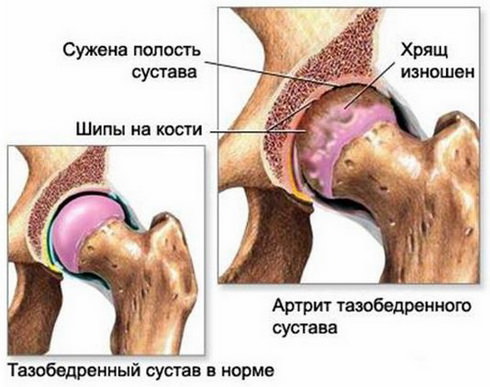 симптомы серонегативного ревматоидного артрита