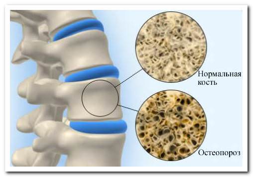 причины остеопороза
