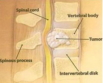 Что такое синдром компрессии спинного мозга thumbnail