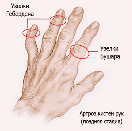 Изображение - Деформация суставов кистей рук uzelki_na_rukah