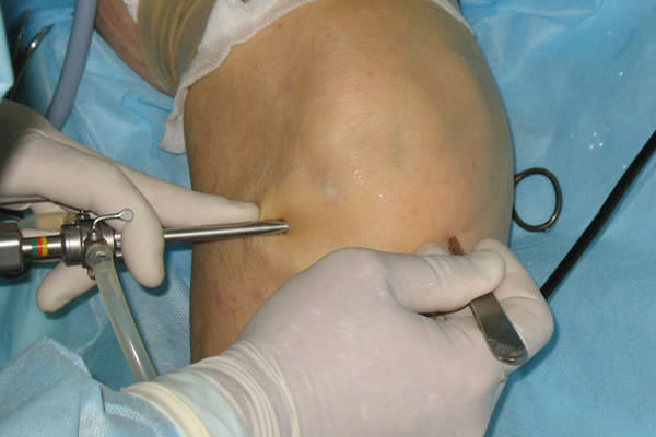 Изображение - Артроскопия коленного сустава где лучше делать artroskopiya_kolennogo_sustava