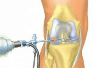 Артроскопия коленного сустава: виды, отзывы