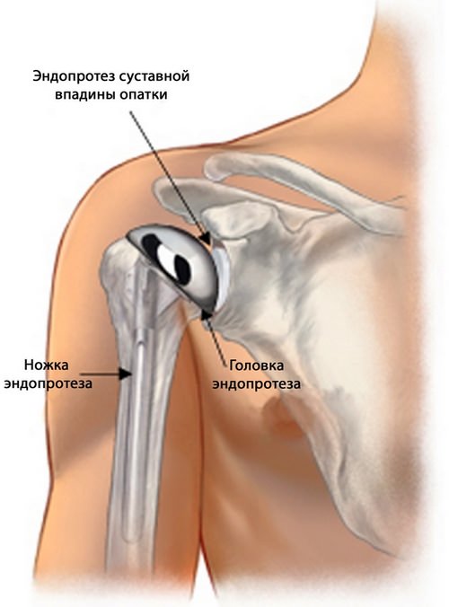 Изображение - Боли после операции плечевого сустава endoprotezirovanie_plechevogo_sustava