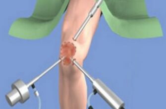 хирургическое лечение мениска коленного сустава