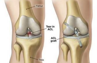 лечение и операция на связках коленного сустава