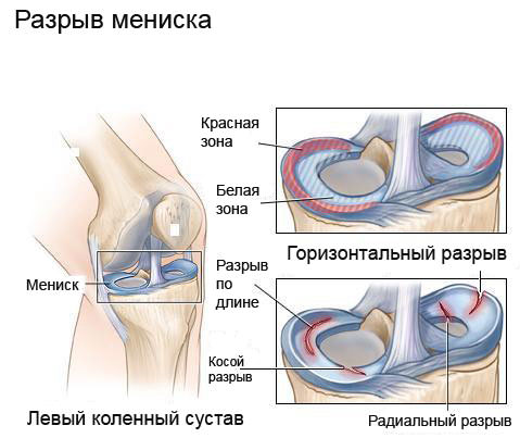 Операция на колене мениск