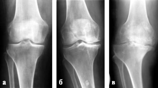 Изображение - Инвалидность при эндопротезировании коленного сустава stepeni_artroza_po_kosinskoy