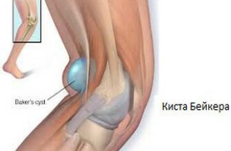 лечение кисты бейкера коленного сустава