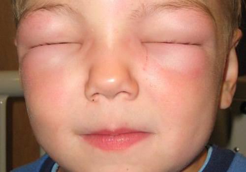 Аллергический артрит у детей симптомы