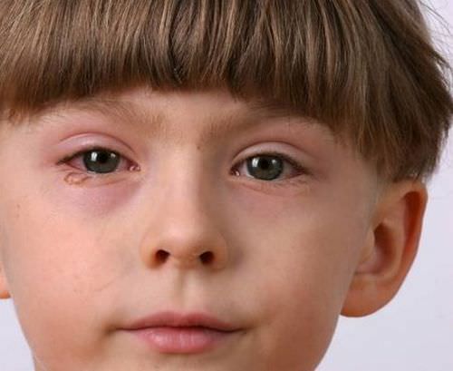 Реактивный артрит у детей симптомы