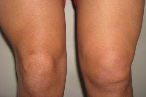  симптомы синовита коленного сустава