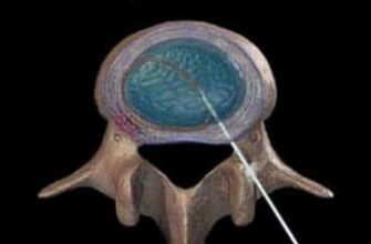 лечение острой боли в спине электротермальная терапия диска
