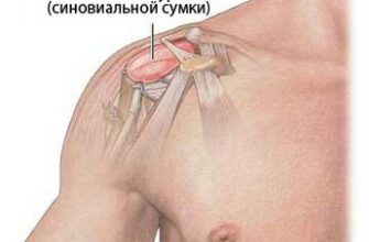 как лечить бурсит плечевого сустава