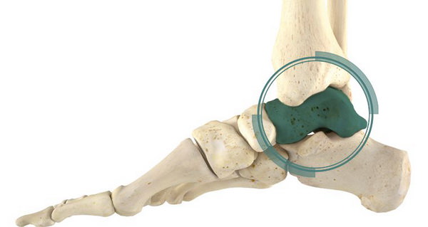 Таранная кость стопы: анатомия и травмы