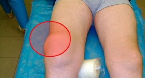 Изображение - Острое воспаление коленного сустава vospalenie-kolena
