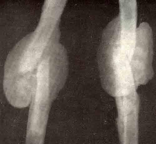 Срастись без операции могут. Периостальная костная мозоль рентген. Параоссальная костная мозоль рентген. Сращение перелома костная мозоль. Срастание костей при переломе на рентгене.