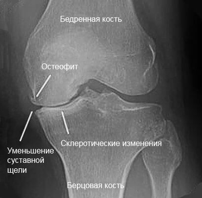 Изображение - Остеофиты коленного сустава как лечить blobid1524263609197