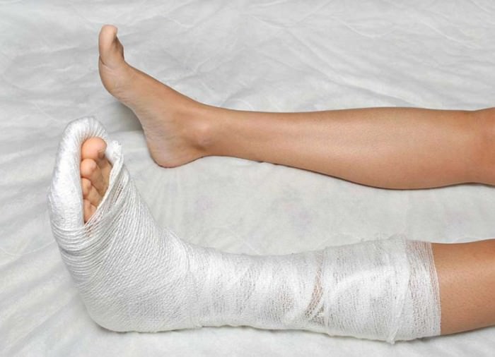 Лангетка на ногу: суппорт голеностопа