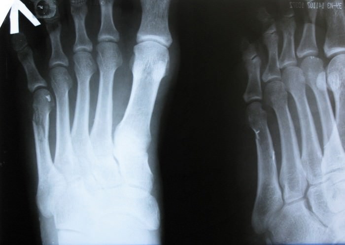 Закрытый перелом основания 5 плюсневой кости левой стопы без смещения фото