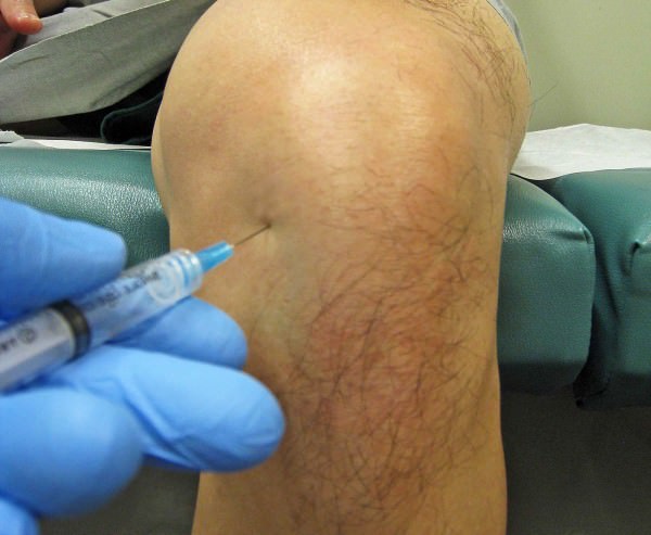 Уколы в коленный сустав при артрозе препараты